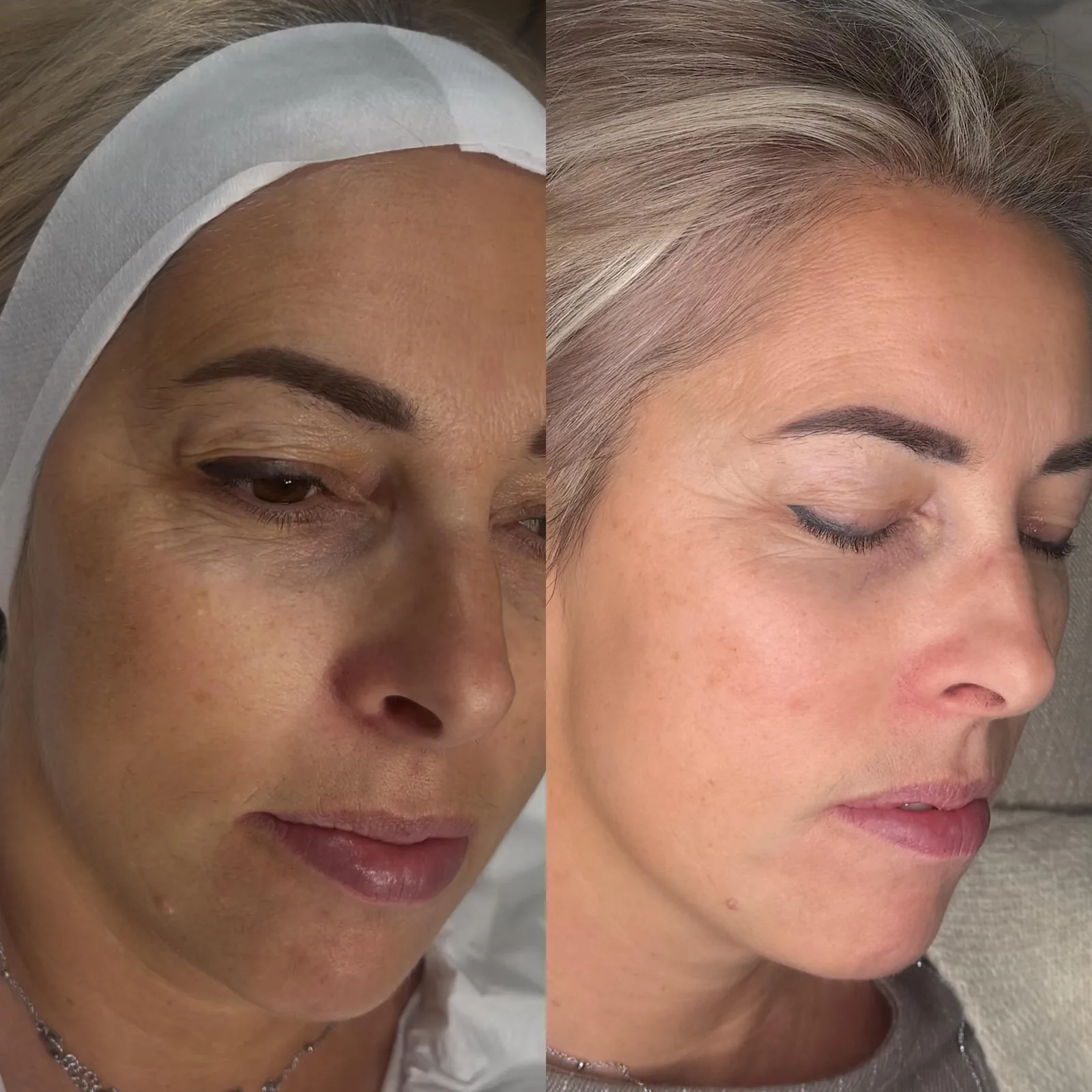 The same client's skin before and after a course of treatment, shown side by side