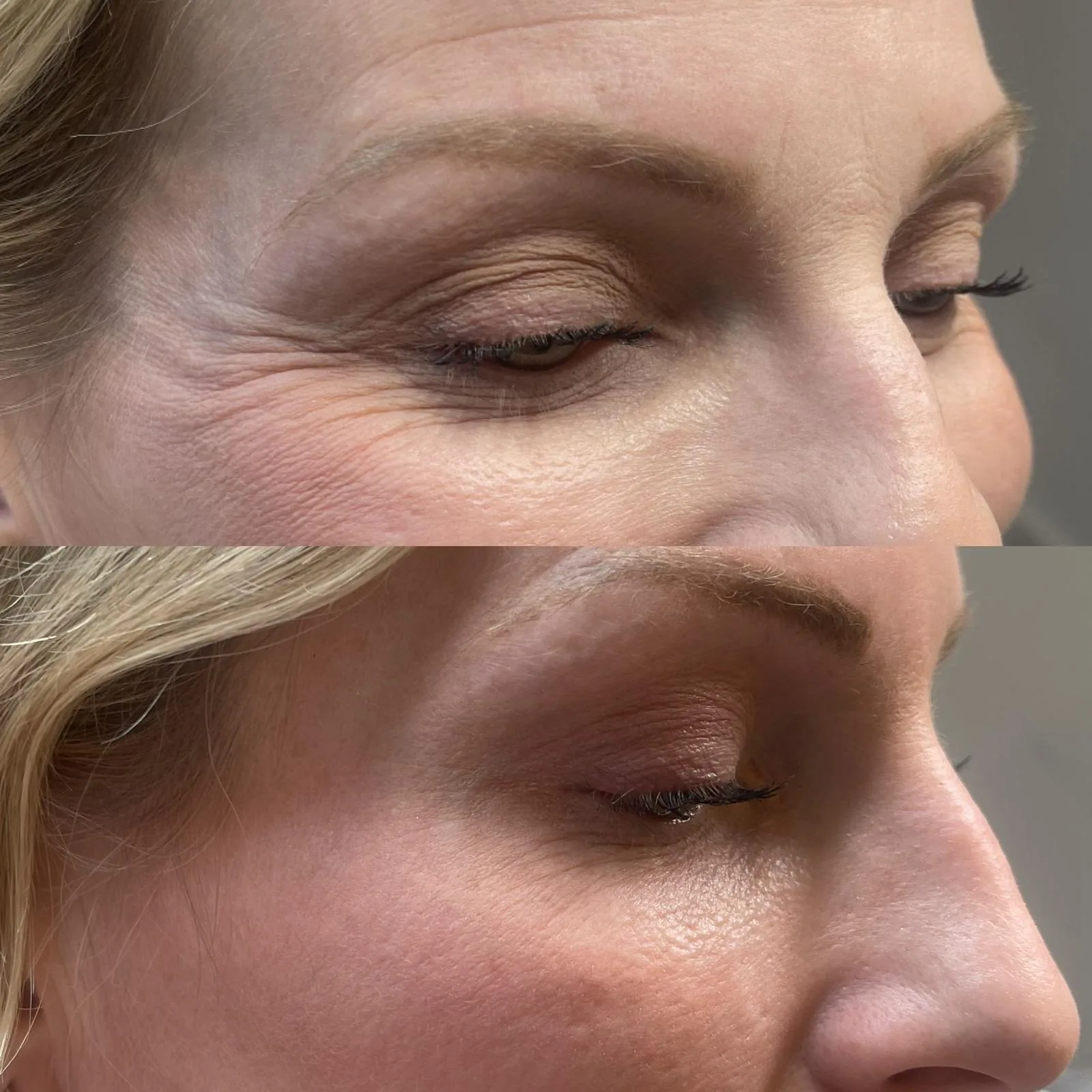 The eye area before and after a course of skin treatment