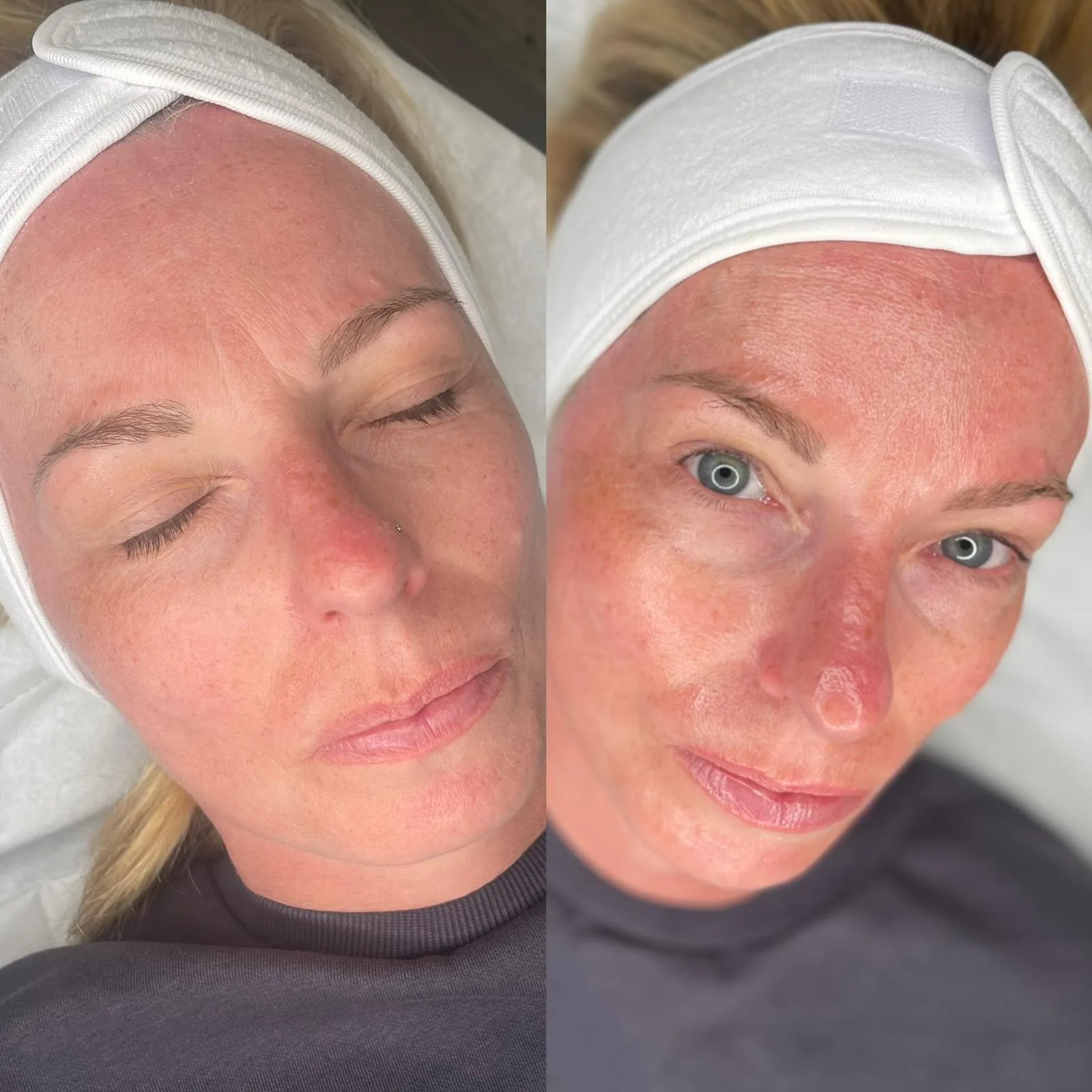 A client's skin before and after a course of treatment