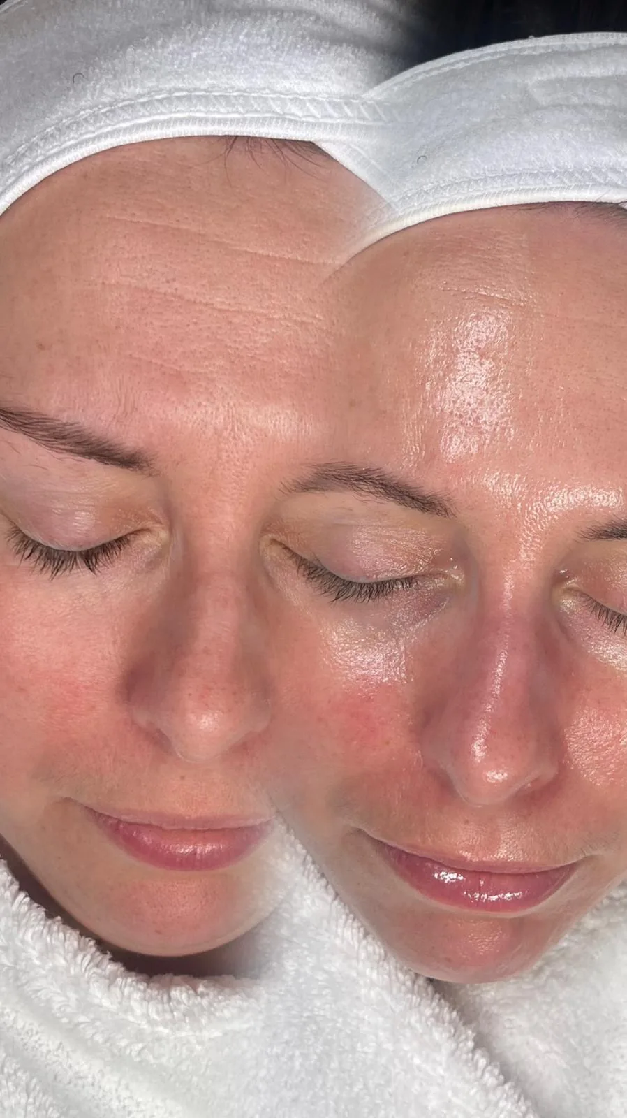 A client's skin before and after treatment, showing more even tone