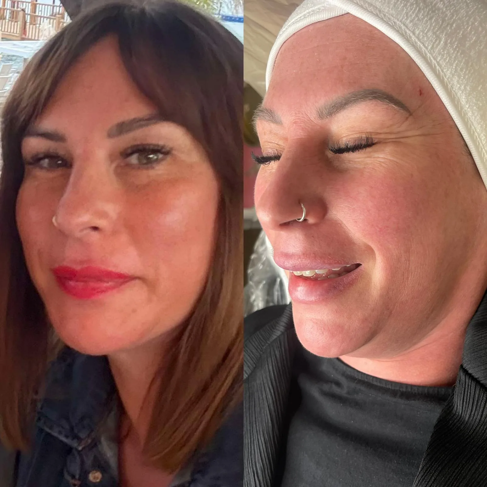 A client's skin before and after treatment, showing smoother texture