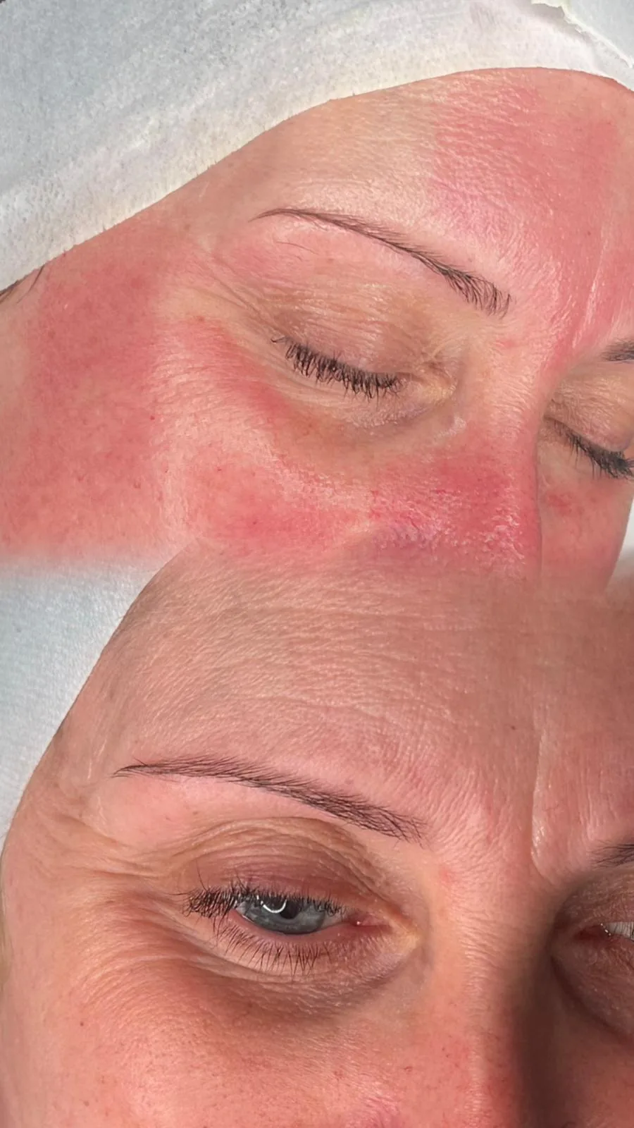 A client's skin before and after treatment, across the cheek and jaw
