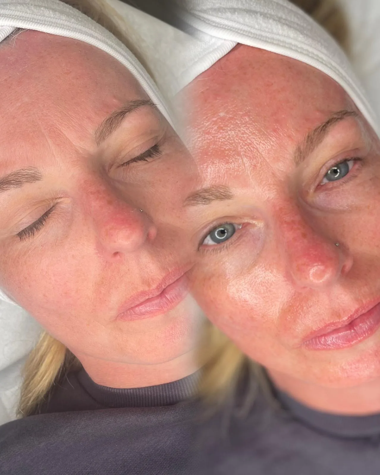 A client's complexion before and after a course of skin treatment