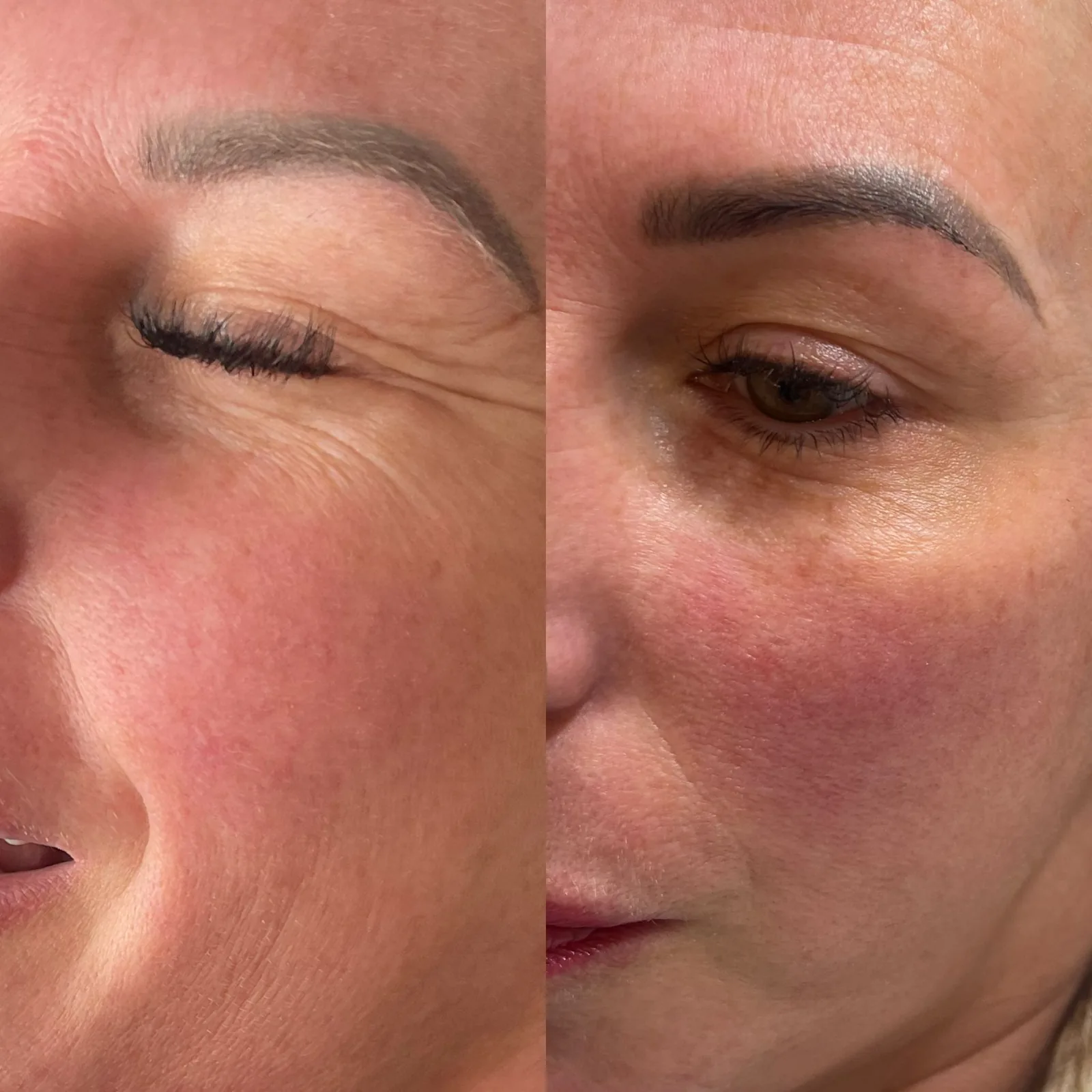 Skin texture around the eye and cheek before and after treatment