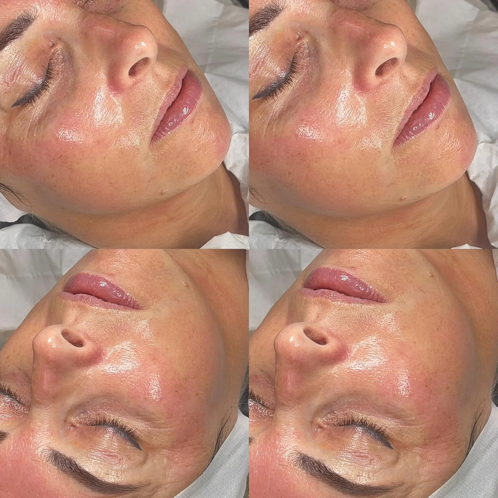 A client's complexion from several angles immediately after a skin treatment